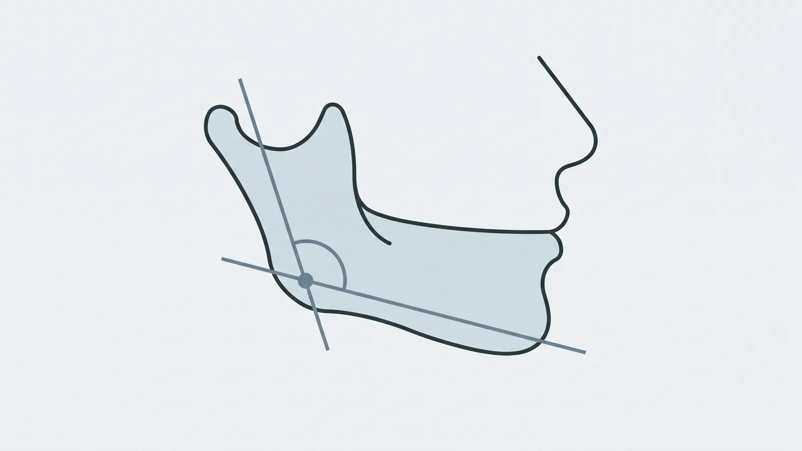 Line illustration of the jaw corner with two lines meeting at an angle and an arc marking the gonial angle
